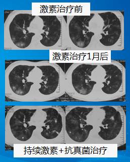 【病例】肺部真菌感染(毛霉菌肺炎)1例CT影像表现 【病例】肺部真菌感染(毛霉菌肺炎)1例CT影像表现