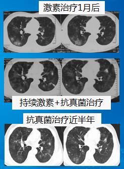 【病例】肺部真菌感染(毛霉菌肺炎)1例CT影像表现 【病例】肺部真菌感染(毛霉菌肺炎)1例CT影像表现