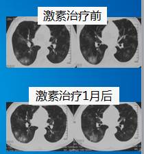 【病例】肺部真菌感染(毛霉菌肺炎)1例CT影像表现 【病例】肺部真菌感染(毛霉菌肺炎)1例CT影像表现