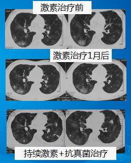 【病例】肺部真菌感染(毛霉菌肺炎)1例CT影像表现 【病例】肺部真菌感染(毛霉菌肺炎)1例CT影像表现