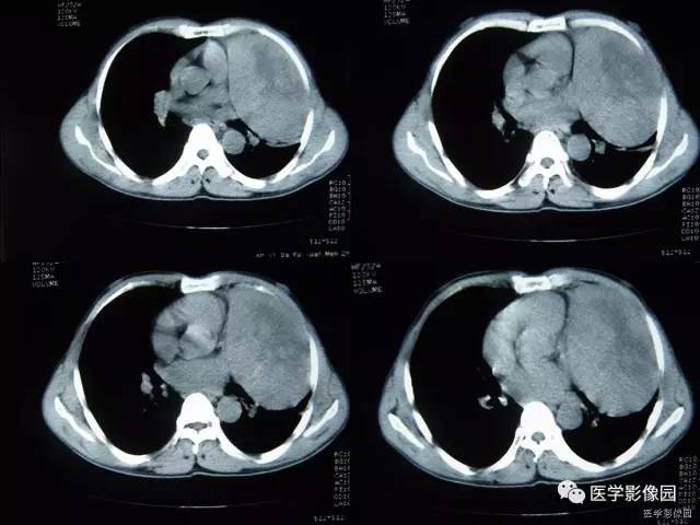 【病例】胸腺类癌1例CT影像表现