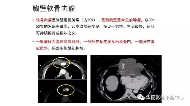 【病例】胸壁软骨肉瘤1例CT影像表现