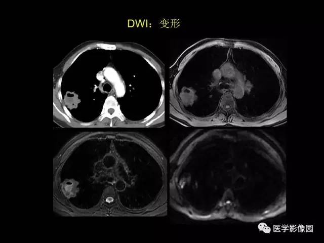 【PPT】肺结节MRI检查技术及诊断思路