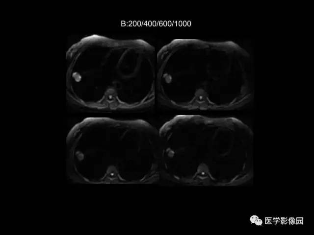 【PPT】肺结节MRI检查技术及诊断思路
