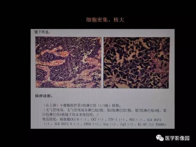 【PPT】肺结节MRI检查技术及诊断思路