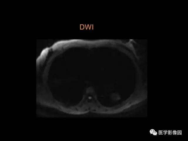 【PPT】肺结节MRI检查技术及诊断思路