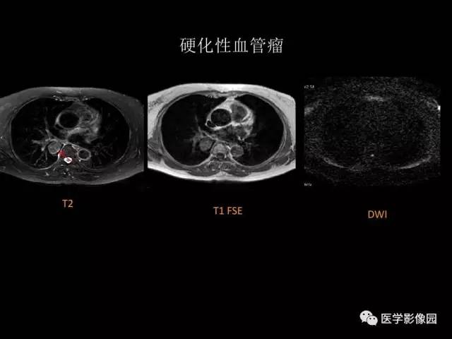 【PPT】肺结节MRI检查技术及诊断思路