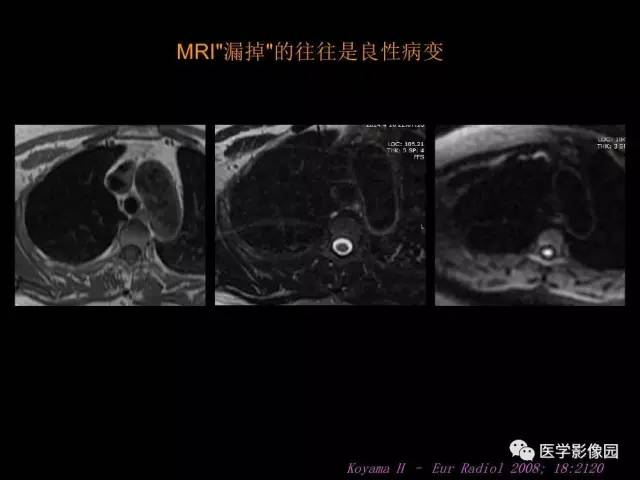 【PPT】肺结节MRI检查技术及诊断思路