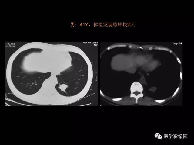 【PPT】肺结节MRI检查技术及诊断思路