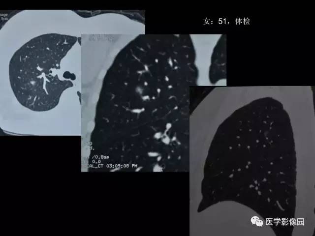 【PPT】肺结节MRI检查技术及诊断思路