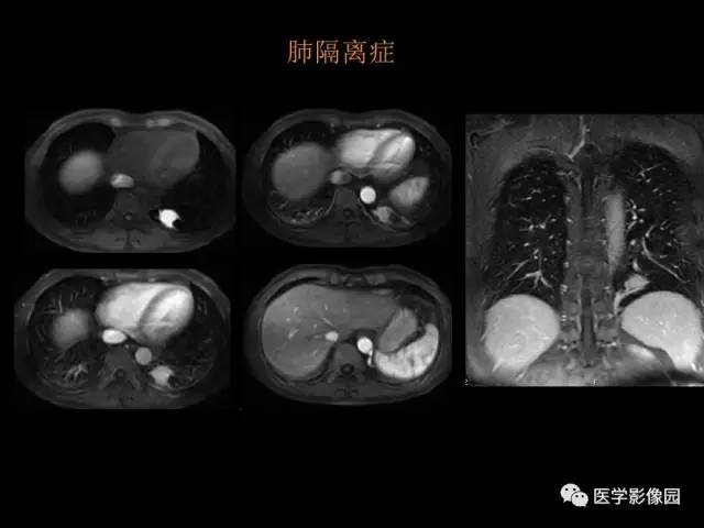 【PPT】肺结节MRI检查技术及诊断思路