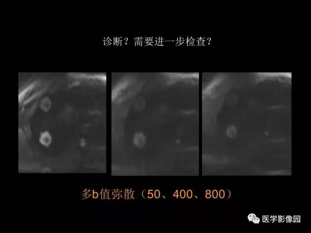 【PPT】肺结节MRI检查技术及诊断思路