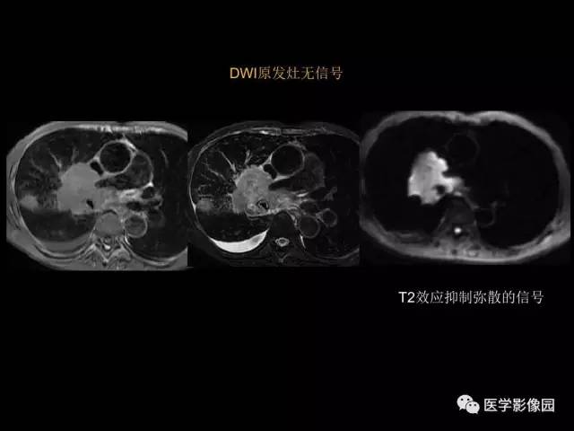 【PPT】肺结节MRI检查技术及诊断思路