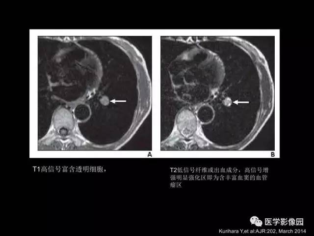 【PPT】肺结节MRI检查技术及诊断思路