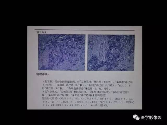 【PPT】肺结节MRI检查技术及诊断思路