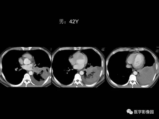 【PPT】肺结节MRI检查技术及诊断思路