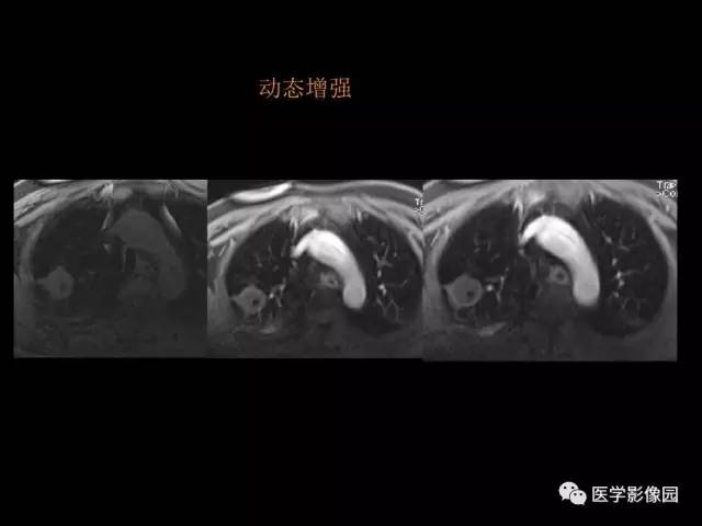 【PPT】肺结节MRI检查技术及诊断思路