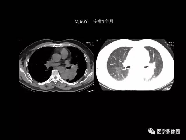 【PPT】肺结节MRI检查技术及诊断思路