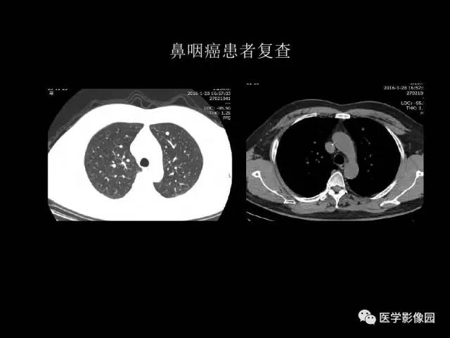 【PPT】肺结节MRI检查技术及诊断思路