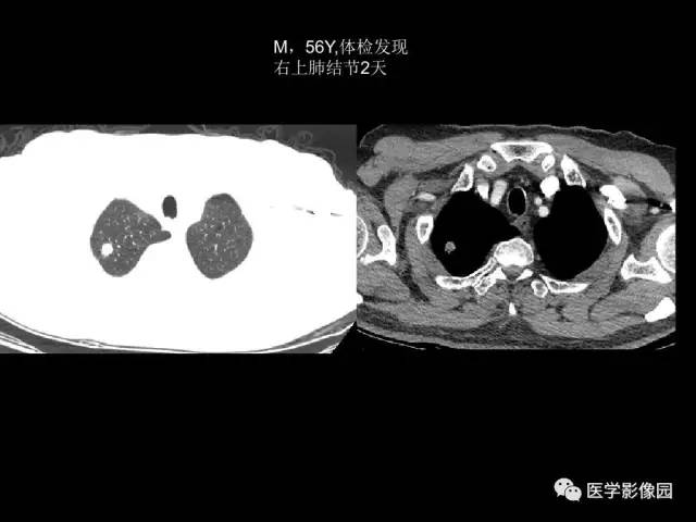 【PPT】肺结节MRI检查技术及诊断思路