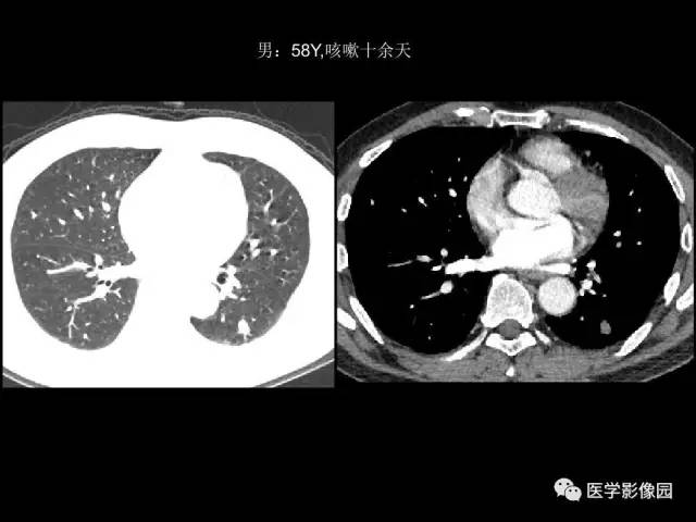 【PPT】肺结节MRI检查技术及诊断思路
