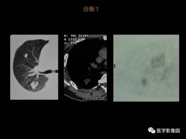 【PPT】肺结节MRI检查技术及诊断思路