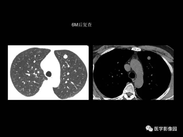 【PPT】肺结节MRI检查技术及诊断思路