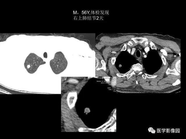 【PPT】肺结节MRI检查技术及诊断思路