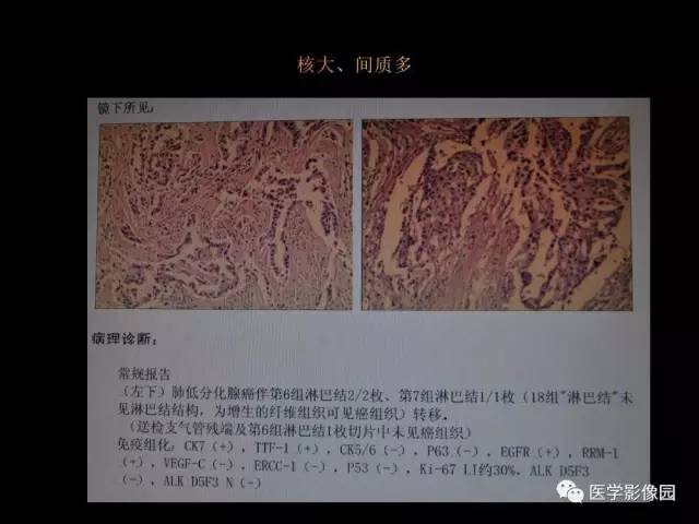 【PPT】肺结节MRI检查技术及诊断思路
