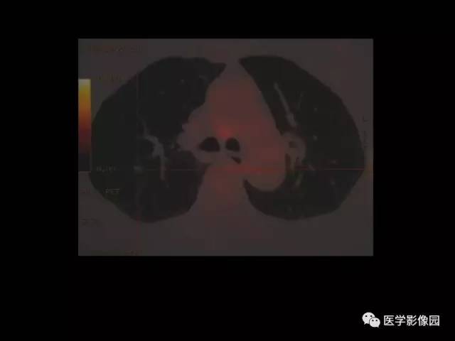 【PPT】肺结节MRI检查技术及诊断思路