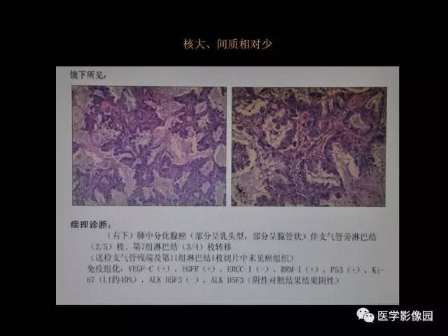 【PPT】肺结节MRI检查技术及诊断思路