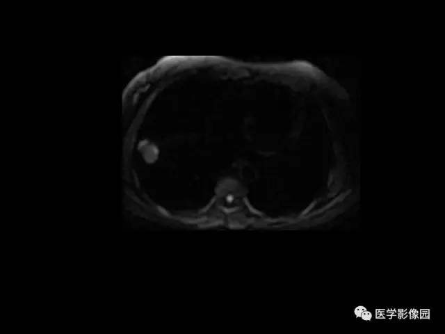 【PPT】肺结节MRI检查技术及诊断思路