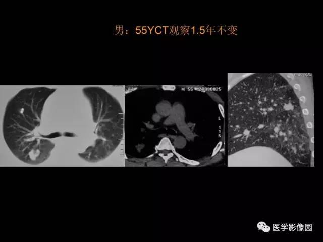 【PPT】肺结节MRI检查技术及诊断思路