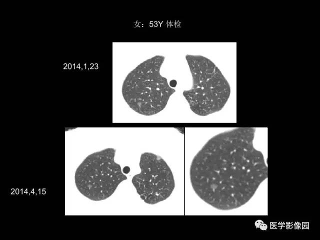 【PPT】肺结节MRI检查技术及诊断思路