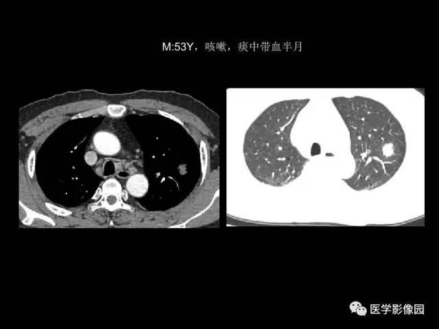 【PPT】肺结节MRI检查技术及诊断思路