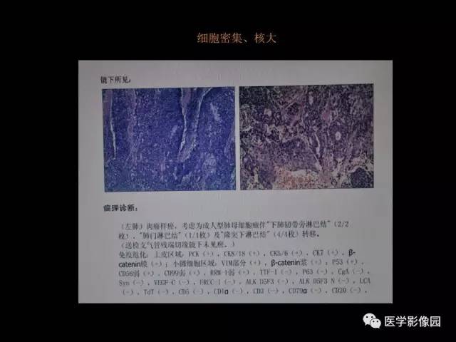 【PPT】肺结节MRI检查技术及诊断思路