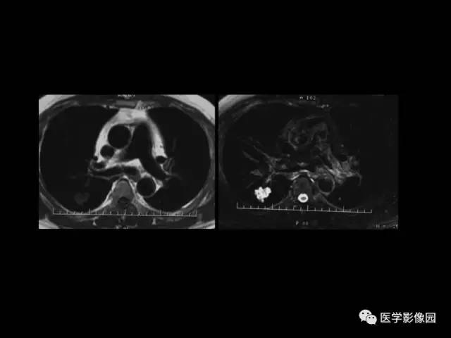 【PPT】肺结节MRI检查技术及诊断思路