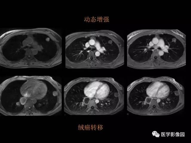 【PPT】肺结节MRI检查技术及诊断思路