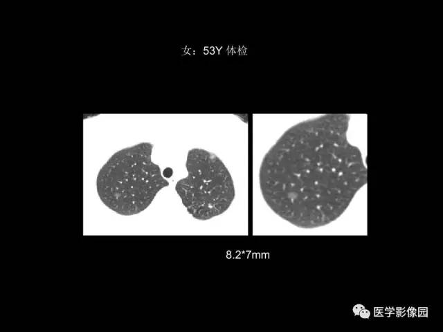 【PPT】肺结节MRI检查技术及诊断思路
