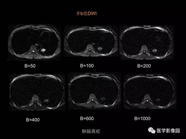 【PPT】肺结节MRI检查技术及诊断思路