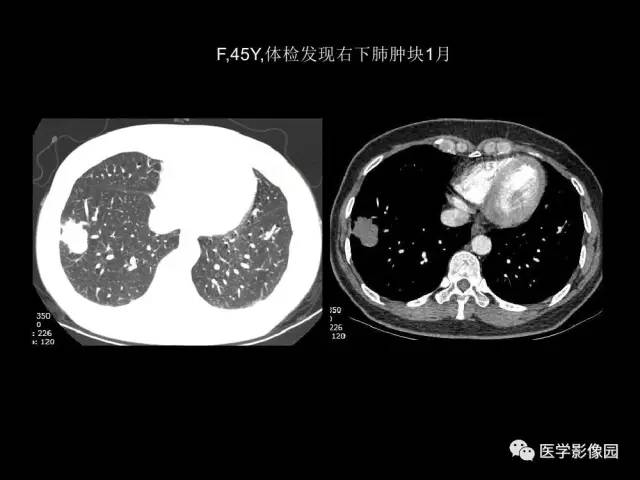 【PPT】肺结节MRI检查技术及诊断思路