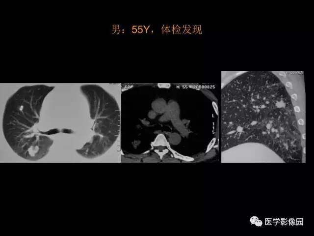 【PPT】肺结节MRI检查技术及诊断思路
