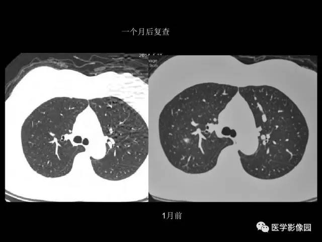 【PPT】肺结节MRI检查技术及诊断思路