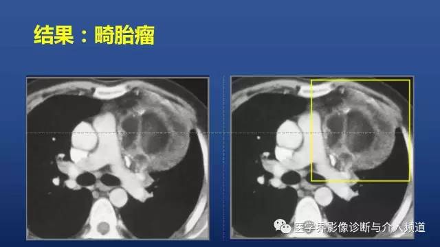 【PPT】胸部疾病鉴别诊断精要