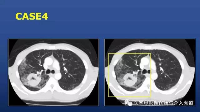 【PPT】胸部疾病鉴别诊断精要