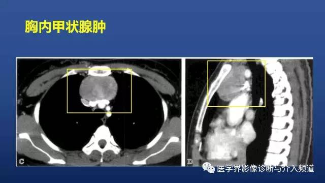 【PPT】胸部疾病鉴别诊断精要
