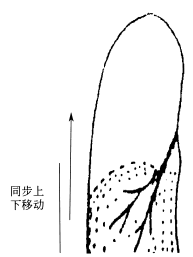 “革尔登征” 的影像表现与临床意义