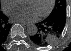 【病例】肺炎性肌纤维母细胞瘤1例CT影像表现