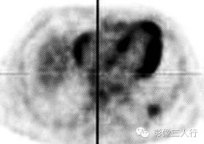 【病例】肺炎性肌纤维母细胞瘤1例CT影像表现