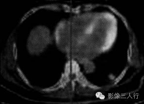 【病例】肺炎性肌纤维母细胞瘤1例CT影像表现 【病例】肺炎性肌纤维母细胞瘤1例CT影像表现